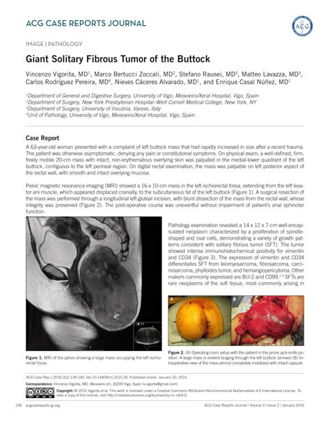 Pdf Giant Solitary Fibrous Tumor Of The Buttock