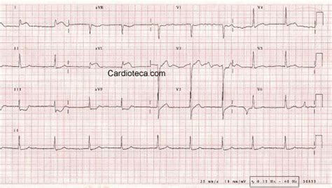 O infarto agudo do miocárdio (iam), também conhecido como infarto ou ataque cardíaco, corresponde à interrupção da passagem de sangue o eletrocardiograma, também conhecido como ecg, é um exame que tem como objetivo avaliar a atividade elétrica do coração, sendo possível. Curso ECG: Infarto agudo de miocardio de arteria coronaria ...