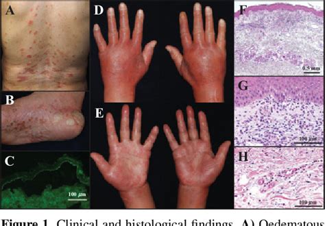 Figure 1 From A Case Of Bullous Pemphigoid Presenting With Severe