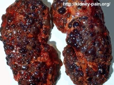 Once your kidneys have failed, you. Protect Your Kidney