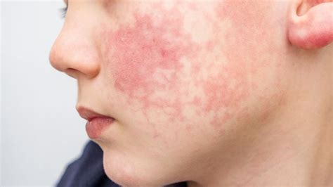 Common Kid Skin Rashes And Sensitivities And Treatments Todays Parent