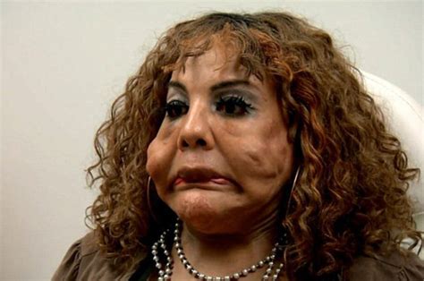 Transgender Woman Who Had Cement Injections Begs Botched Surgeons To