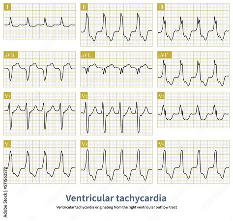Ventricular Tachycardia Originating From The Right Ventricular Outflow