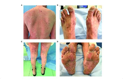 Severe Psoriasis In A Patient With Common Variable Immunodeficiency