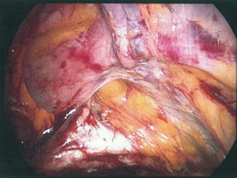 Photos Laparoscopic Inguinal Hernia Repair With Direct Type Hernia