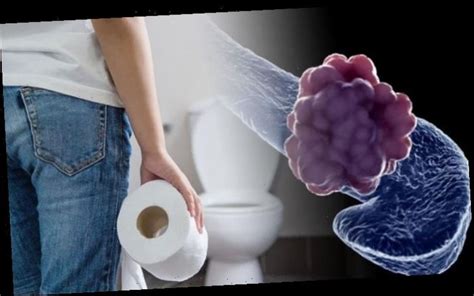 Pancreatic Cancer Symptoms Four Signs In Your Stools That Could Signal