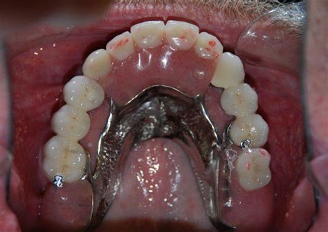 Partial Dentures 19th Avenue Dental