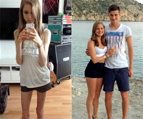 Teen Credits Falling In Love Remarkable Recovery From Anorexia
