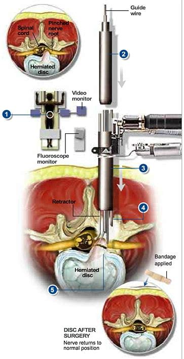 Micro Endoscopic Discectomy The Southeastern Spine Institute