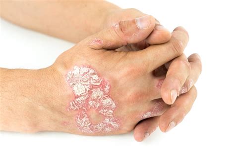 Plaque Psoriasis Pictures Symptoms And Severity