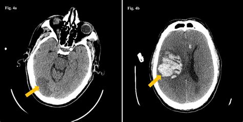 Cureus Acute Ischemic And Hemorrhagic Stroke In Covid 19 Mounting