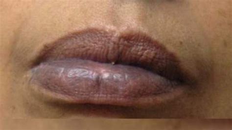 Blue Lips Are Warning Sign Of These Serious Health Problems Blue Lips