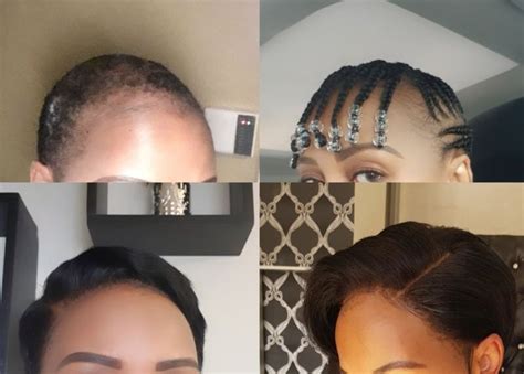 African Women On The Shame Of Hair Loss Bbc News