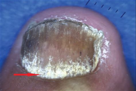 The Grid Pattern Of White Superficial Onychomycosis Indian Journal Of
