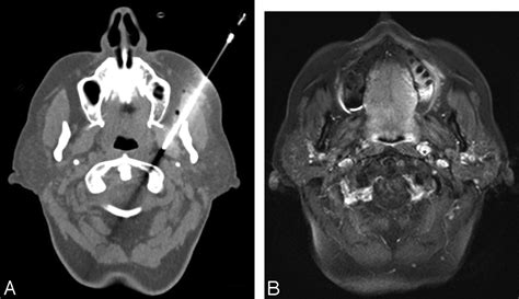 Fig 5 Retropharyngeal Lymph Node Metastasis From