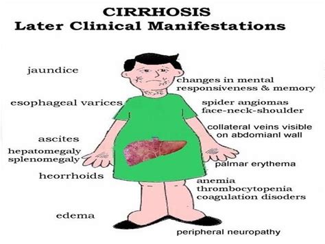 Cirrhosis Of The Liver And The Liver Functions Nurse Medical