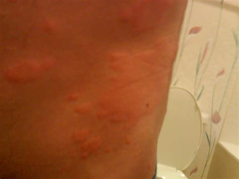 Awesome 10 Stress Rash Hives All Over Body Pics Etuttor