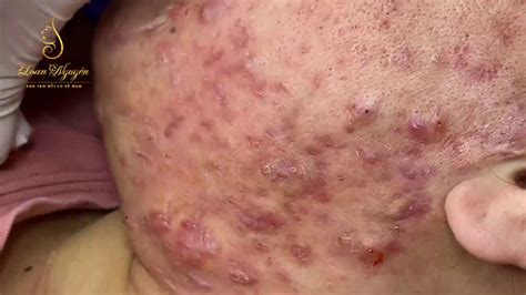 Remove Inflammatory Acne Pustules For Young Girls 215 Loan Nguyen
