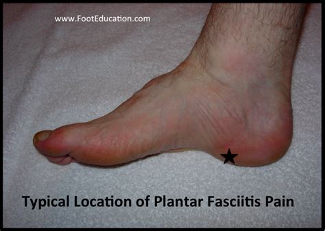 Plantar Fasciitis Footeducation