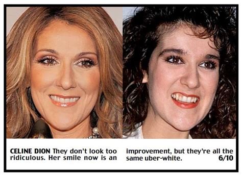 Celine Dion New Teeth Plastic Surgery Pinterest Teeth Then And Now And Whiter Whites