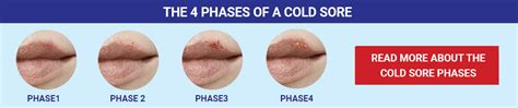 What Is A Cold Sore The Most Common Viral Infection