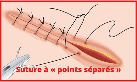 Ace Sol Industriel Ablation De Fils De Suture Surjet Toxicomane