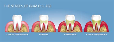 Understanding Gum Disease Strayt