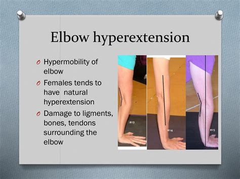 Ppt Elbow Injuries Powerpoint Presentation Free Download Id2188505