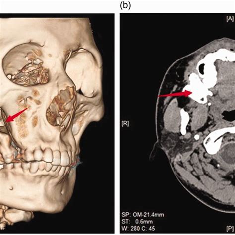 Preoperative Computed Tomography Images A Three Dimensional