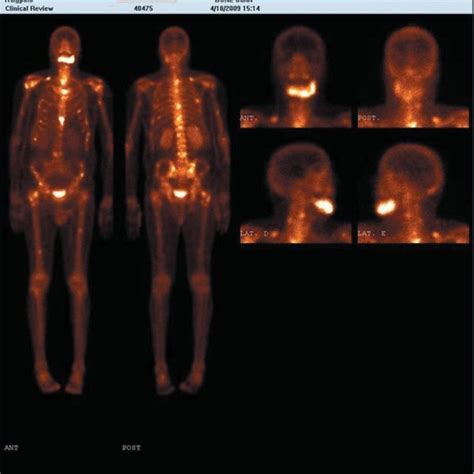 Whole Body Bone Scintigraphy Increased Uptake Of The Radiocontrast
