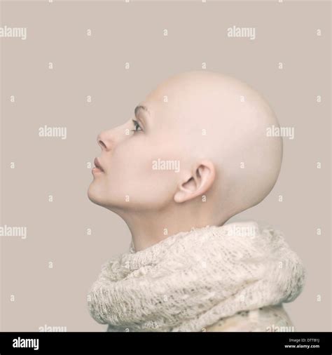 Caucasian Woman With Bald Head Stock Photo Alamy