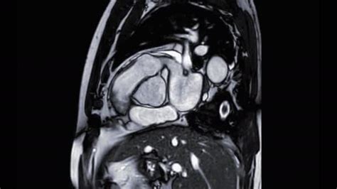 Mri Heart Cardiac Mri Magnetic Resonance Imaging Heart Rvot View