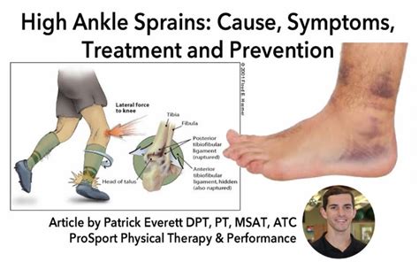 Ankle Sprain Causes Treatment Prevention Reliva Physiotherapy Rehab