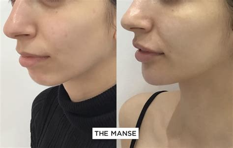 Chin Fillers Performed At Our Sydney Clinic By Dermal Filler Expert