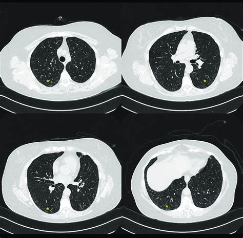 High Resolution Chest Computed Tomography Showing Innumerable Diffuse