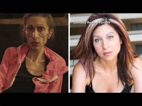 Anorexic Woman S Dramatic Transformation Youtube