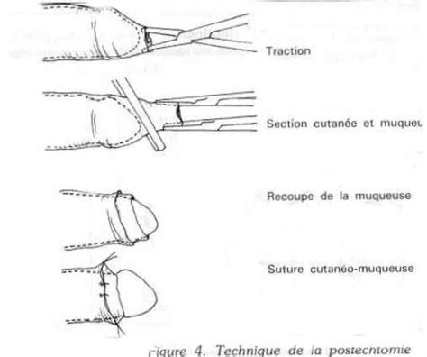 Photo De Circoncision