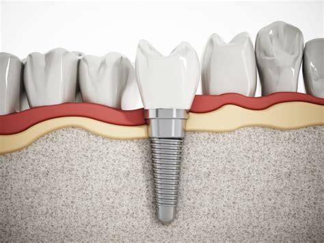 Dental Implant Vs Crown Which Is The Best Fit Orbit