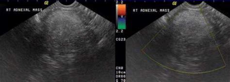 Dermoid Cyst Of Ovary Highly Echogenic Right Ovarian Mass Showing No
