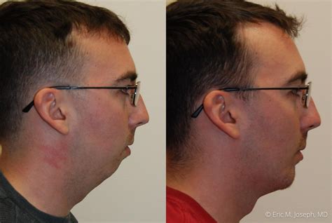 Eric M Joseph Md Chin And Neck Before And After Chin Implant With Neck