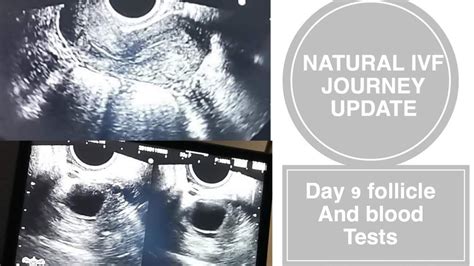 Ivf Journey Day Follicle Scan And Blood Tests Update Kato Repro