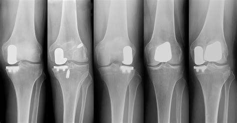 Nyc Patellofemoral Partial Knee Replacement Robotic Partial Knee