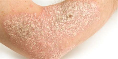 Severe Psoriasis Linked To Higher Risk Of Earlier Death Consumer