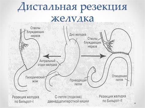 Диета послеоперационная при резекции желудка Диета После Резекции Желудка По Бильрот 2 — Похудение Диета Правильное Диета После Резекции Желудка По Бильрот 2 — Похудение Диета Правильное Диета послеоперационная при резекции желудка