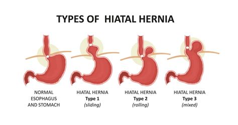 Herniatypes2 Association Of South Bay Surgeons
