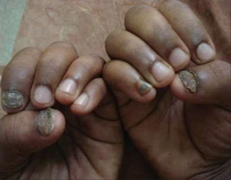 Fungal Nail Infections Treatment And Causes Patient