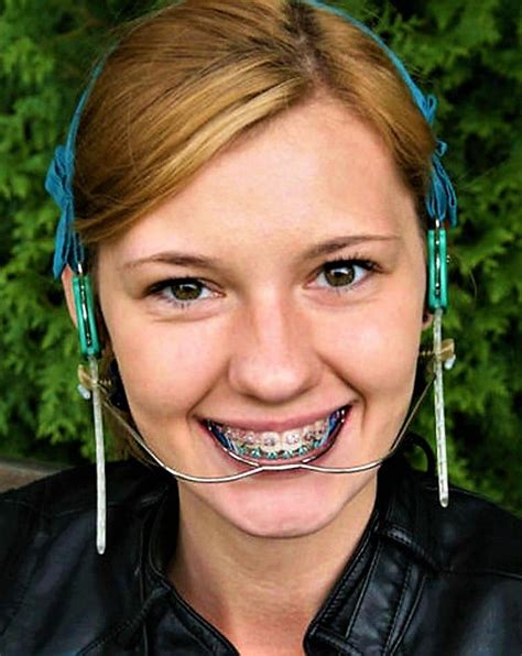 Pin By Randal Tucker On Orthodontic Headgear Braces Braces Girls