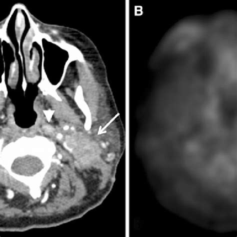 Hilum Of Lymph Node Can Be Demonstrated By Multiple Imaging Methods A