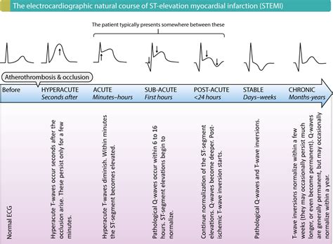 Ecg changes and indicators mi. The ECG in assessment of myocardial reperfusion - ECG learning