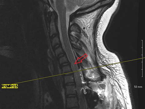 Cureus Cervical Spine Injury Following Thoracic Spinal Fusion For
